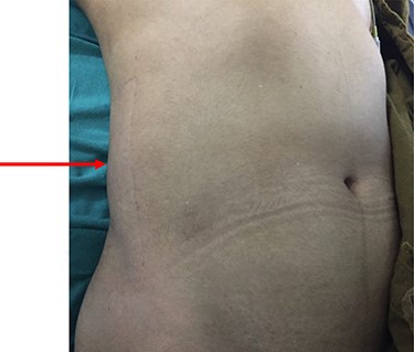 Swelling noted on the postero-lateral aspect of the abdominal wall.