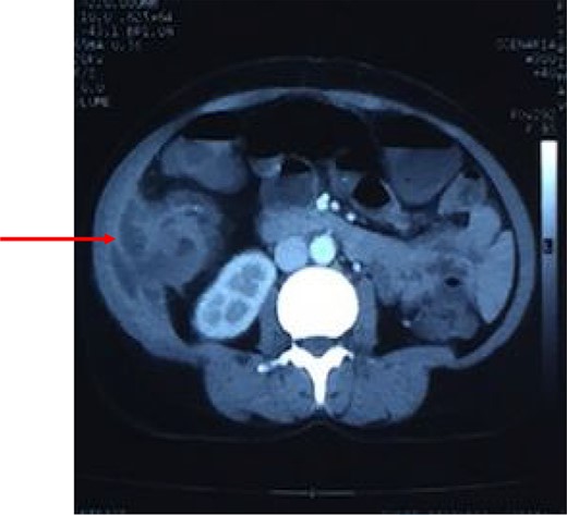 Computed tomography of the abdomen showing perforation of the tumor through muscles of lateral abdominal wall with abscess formation as seen on CT scan.