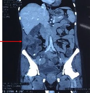 Coronal reconstruction of CT shows mass extending from colon and invading into anterior abdominal wall. Arrows indicate the point of exit of mass through the abdominal wall musculature.