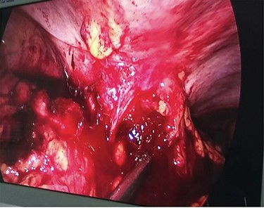 Diagnostic laparoscopy showing ascending colon adherent to anterior abdominal wall.