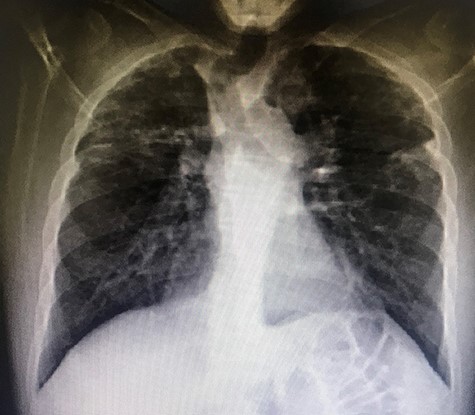 Left pneumothorax in a 37-year-old patient with IPPFE.