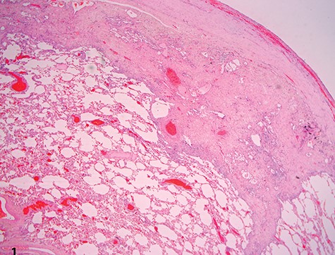 Low-power view showing dense pleural fibrosis associated with subjacent intra-alveolar fibrosis and accompanying septal elastosis, the latter being better seen on elastic Van Gieson stain; note the lack of fibrosing process away from the subpleural region (hematoxylin–eosin, original magnification ×20).