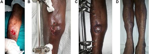 A: The wound defect prior to the raising of the hemisoleus muscle flap and STSG. B: At 1 month post-operation with minimal skin graft loss laterally. C: At 2 months post-operation; completely healed. D: At 2 years post-operation; atrophy of the hemisoleus muscle is appreciated.
