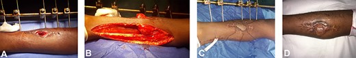 A: The wound defect prior to the raising of the hemisoleus muscle flap. B: The medial incision, demonstrating that the hemisoleus muscle has been divided at its insertion, raised and will cover the defect, but it is not yet inset. C: The hemisoleus muscle has been inset, sutured in place and covered with an FTSG. Note the drain in situ within the now closed medial incision. Silk ties were employed to bolster and protect the graft. D: Completely healed now with an STSG at 1 week shy of 6 months.