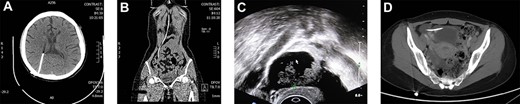 (A and B) CT showed the shunt from lateral ventricle to abdominal cavity; (C) Ultrasound of gynecology showed a mass measuring about 3.5 × 2.3 cm in the right adnexa, which was mainly cystic, with solid irregular protrusions ranging from 2.7 × 1.6 cm inside, in which blood flow signals were explored; (D) Pelvic CT scan suggested drainage catheter was located in the front of the uterus.