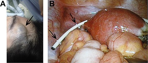 (A) Swelling forehead hemangioma in Trendelenburg position; (B) The end of the catheter was exposed and clear cerebrospinal fluid was dripped from the catheter continuously.