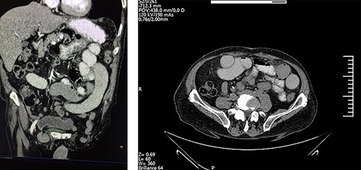 Abdominal CT indicating bilateral bowel obstruction.