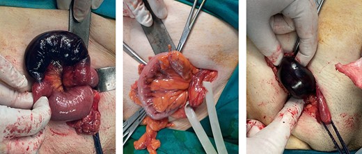 Strangulated bilateral femoral hernia; the right hernia included gangrenous loops of the ileum and the left one included a small part of the sigmoid colon.