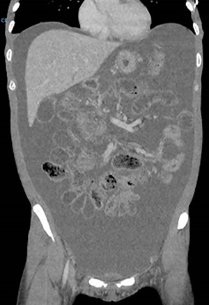 Initial CT scan performed on admission.