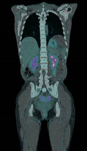 PET-CT.