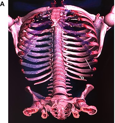3D computed tomography, the needle is seen in the abdomen.
