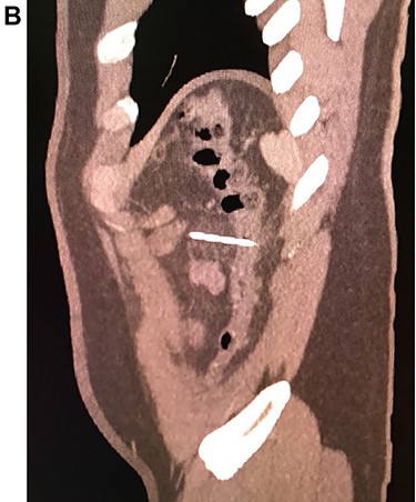 CT, the needle is seen perforated in the colonic wall.