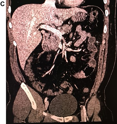 CT, needle is seen in the abdomen.