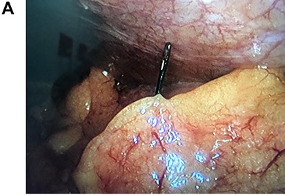 The needle is seen in the colonic wall.