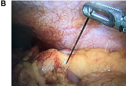 The needle is removed from the colon.