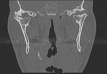 CT in coronal view with pathognomonic picture of deforming temporomandibular joint arthrosis on both sides.