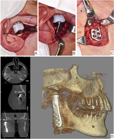 Intraoperative image showing the articular fossa (A) in combination with the articulating condylar component (B), the fixed ramus component (C) and the postoperative CBCT of the right side (D).