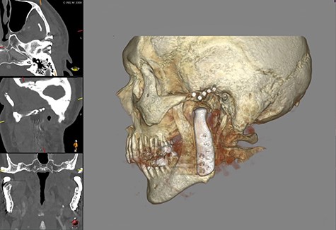 Shows postoperative CBCT after left TMJ replacement, 9 months after the right side.