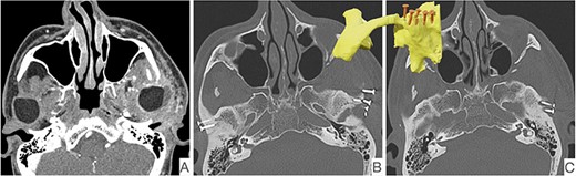 CT scan showing radiological signs of loosening of the left fossa component. On the left, the presentation of the periprosthetic edema (A), fracture of an osteosynthesis screw (B) and the osteolysis around the screw shafts (C).