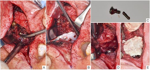 Intraoperative images show the removal of the loosened fossa component of the left side with removal of the shortened (broken) osteosynthesis screw (A), mobilization of the fossa component (B), the broken osteosynthesis screw (C), view of the condylar component (D) and condition after insertion of the patient-specific fossa component made of COPAL® bone cement (E).