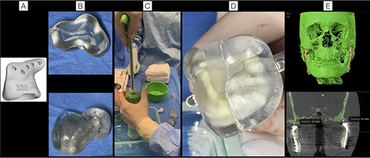 Shows the workflow to the PSI-COPAL®-TMJ fossa from the surface scan of the original fossa drill template (A), the creation of a two-part press mould (B), the intraoperative mixing of the bone cement (C), the shaping of the articular fossa (D) to the postoperative CT scan showing the symmetrical distance from condyle head to skull base on both sides (E).