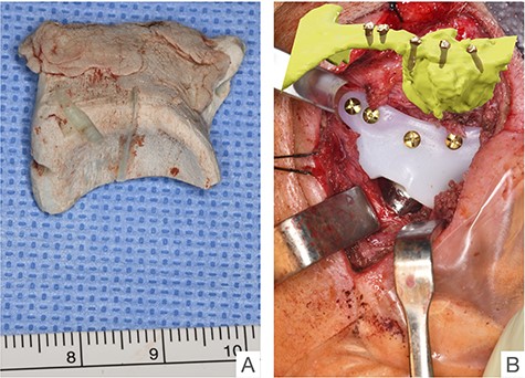 Condition of the PSI-COPAL®-TMJ fossa after explantation and situs after implantation of the newly fabricated UHMWPE articular fossa after healing of the bony implant site.