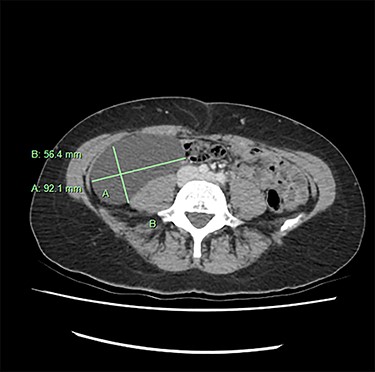 Abdominal CT shows a large retroperitoneal cystic lesion.