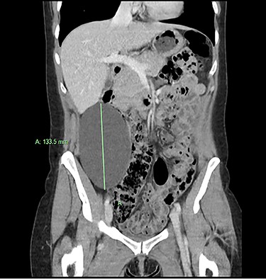 Coronal CT view of large retroperitoneal cyst.
