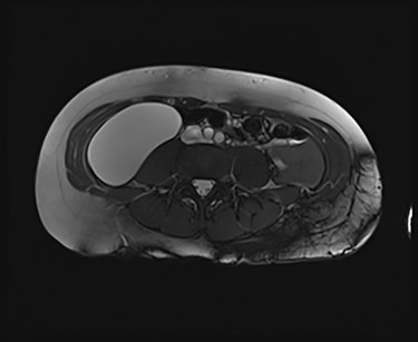 An MRI T2 axial view of the cyst.