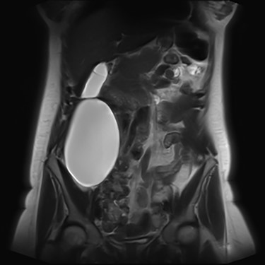 An MRI T2 coronal view of the cyst.