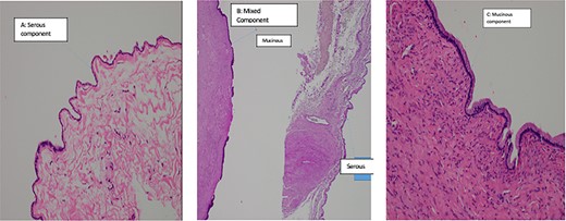 Histopathalogy slides of 47-year-old patient. (A) shows serous component. (B) shows mixed component. (C) shows mucinous component of the benign cyst.