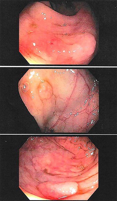Examples of several polyps found on routine colonoscopy in the cecum (top, middle) and ascending colon (bottom).