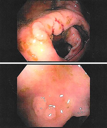Examples of polyps found on follow-up colonoscopy in the ascending colon (top) and descending colon (bottom).