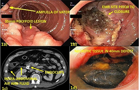 (a) Thirty-five millimeters polypoid lesion on posterior wall of second portion of the duodenum, adjacent to the ampulla of Vater; (b) Mucosal defect after EMR of the lesion; (c) Computed tomography post-procedure Day 1 with free, intraperitoneal air and fluid adjacent in the right paracolic gutter and retroperitoneum suggesting perforation; (d) Endoscopy post-procedure Day 6 with 40 mm defect at site of prior closure, bile-stained necrotic tissue overlying retroperitoneum and free mucosal edges.