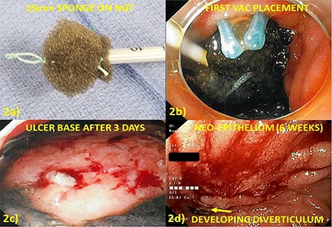 (a) Endoluminal vacuum closure sponge created by suturing a 15-mm piece of black sponge to an 18fr NGT with 0-ethibond suture. A loop is created to aid in manipulation and placement at the tip of the sponge. (b) Cap-aided placement of sponge in defect which is held in place by activating suction. (c) Debridement of retroperitoneal necrosis at first exchange (3 days after placement). (d) Defect appearance at 6 weeks after cessation of therapy with neo-epithelium covering nearly the entire defect.