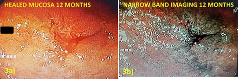 (a) Defect appearance at 12 months on white light and (b) narrow-band imaging without evidence of recurrence or other abnormality.