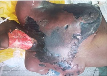 Anterior aspect of the neck and chest.