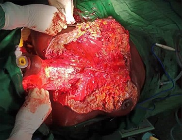 Chest debridement under general anaesthesia.