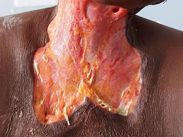 Ulcerations of the neck to the upper third of the chest.