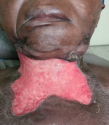 Deviation of the lower lip to the right.