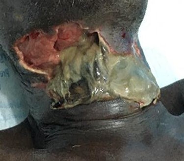 Large ulceration of right submandibular region.