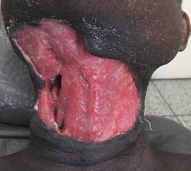 Skin defect after wound debridement.