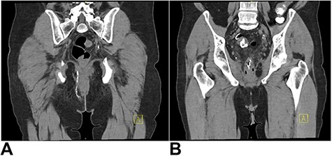 (A) CT fistulogram showing a long fistulous tract extending from the right peri-anal region, superiorly in the ischiorectal fossa, traversing the inferior aspect of the levator ani and extending around the right of the anal canal and rectum; (B) superiorly, it extended into a thick-walled inflamed segment of sigmoid colon with numerous diverticulae; contrast can be seen entering the sigmoid loop.