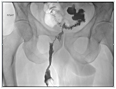 Fistulogram of colocutaneous peri-anal fistula.