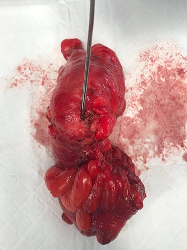 Surgical specimen showing opening of the fistula tract from a sigmoid colon diverticulum