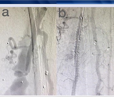(a) Posterior Tibialis artery before intervention, (b) after endovascular stent graft deployment.