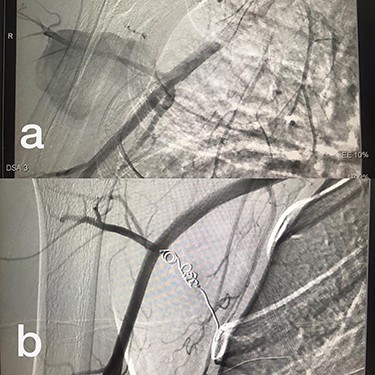 (a) Branch of Axillary artery before intervention, (b) after coil embolization.
