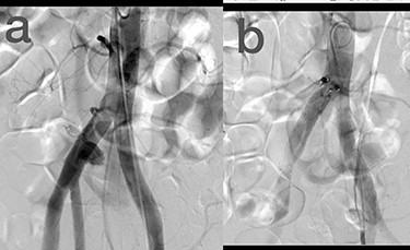(a) Common iliac artery before intervention, (b) after stent-graft deployment.