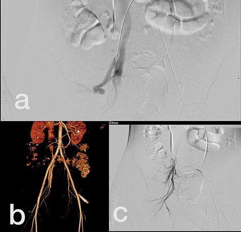 (a) Internal iliac artery before intervention, (b and c) after coil embolization.