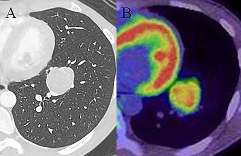 Chest computed tomography (CT) showing a 35-mm nodule in the lower lobe of the left lung (A). Fluorodeoxyglucose-positron emission tomography (FDG-PET) showing high accumulation in the nodule (SUVmax: 5.9; B).